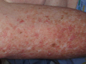 Dermatomyositis of the arm 