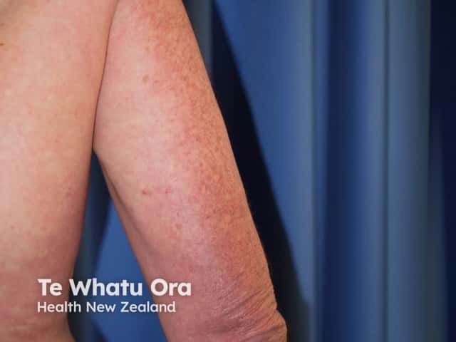 Photosensitive rash on the upper arm