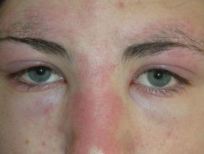 dermatomyositis eyelids 01