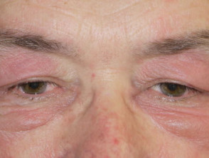 Dermatomyositis of the eyelids