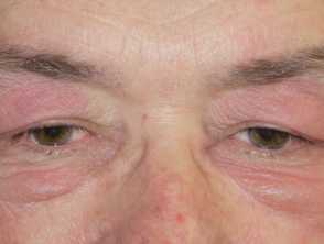 dermatomyositis eyelids 3