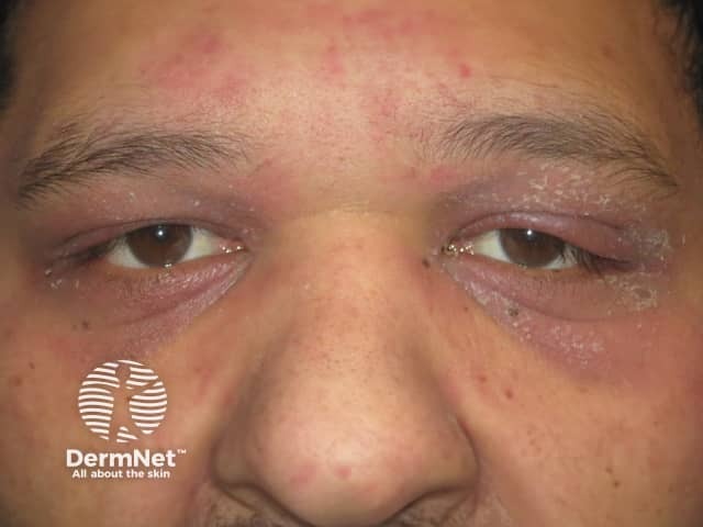 Heliotrope rash of the eyelids