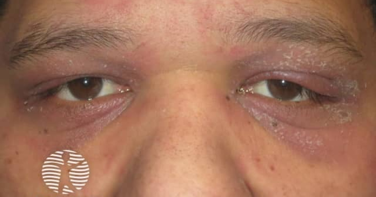 Dermnet® Dermatomyositis Of Eyelids Image