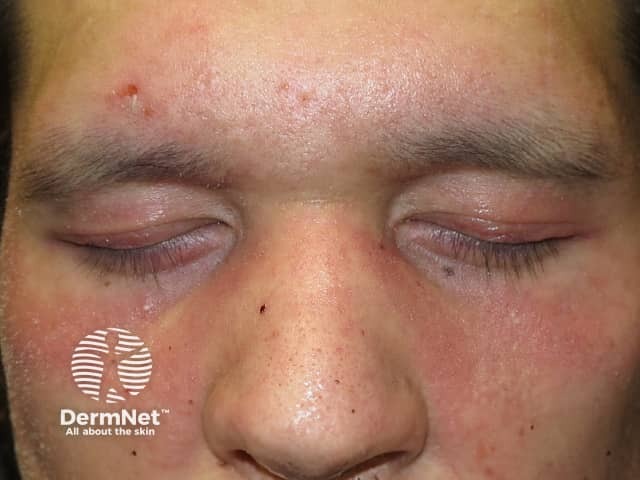 Dermatomyositis of eyelids