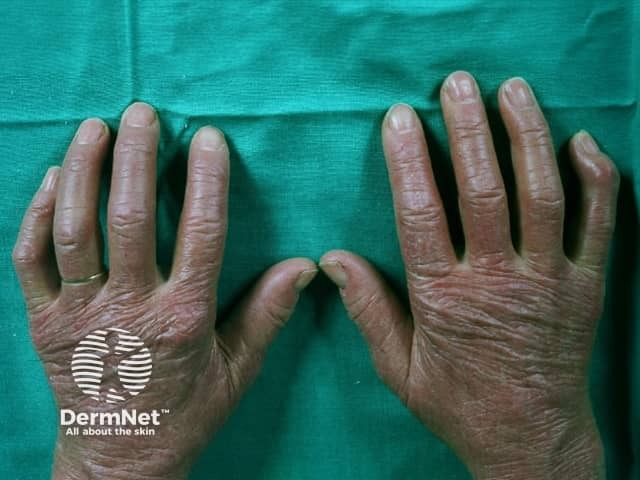 Dermatomyositis of the hands
