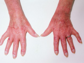 Dermatomyositis of the hand 