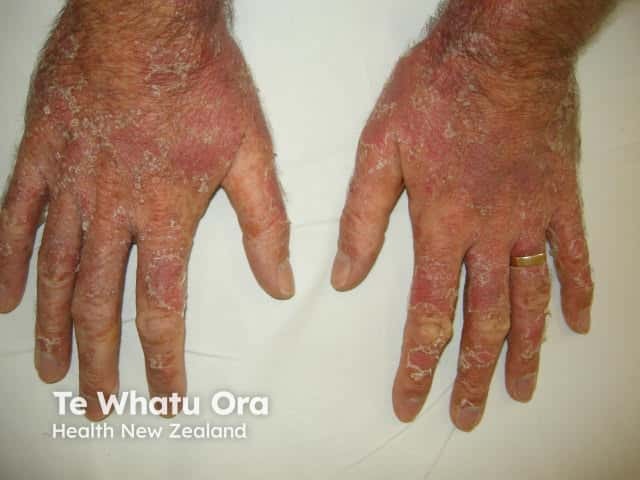 Dermatomyositis of the hand