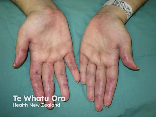 Dermatomyositis of the hand