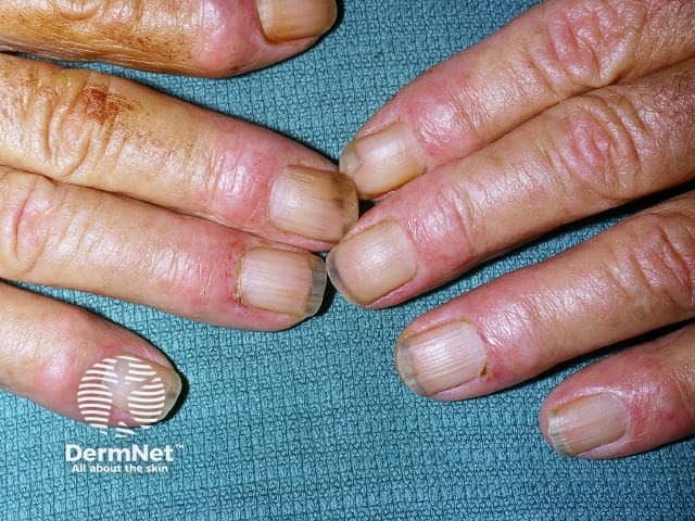 Loss of cuticles with nailfold redness and Gottron papules