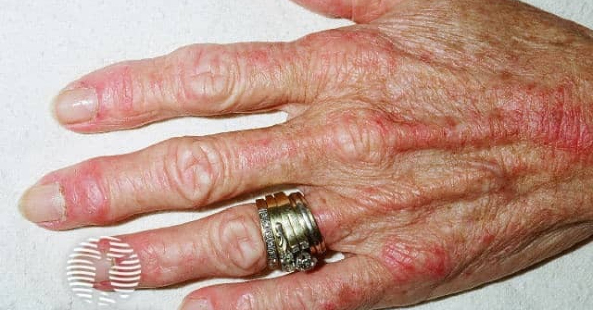 Dermatomyositis of the hand image