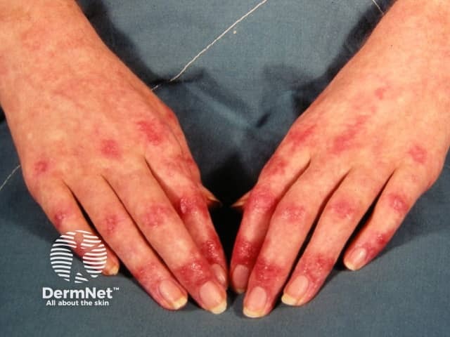 Gottron papules over the joints of the hands