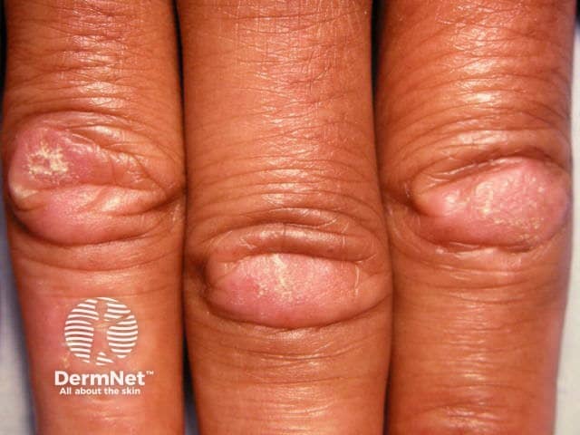 Gottron papules over finger joints