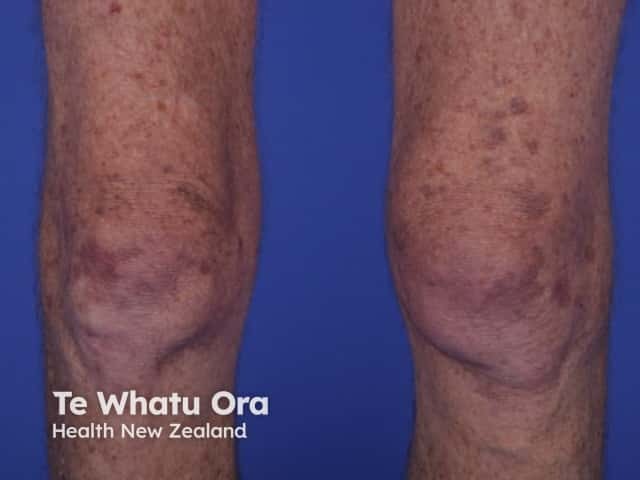 Dermatomyositis of the leg