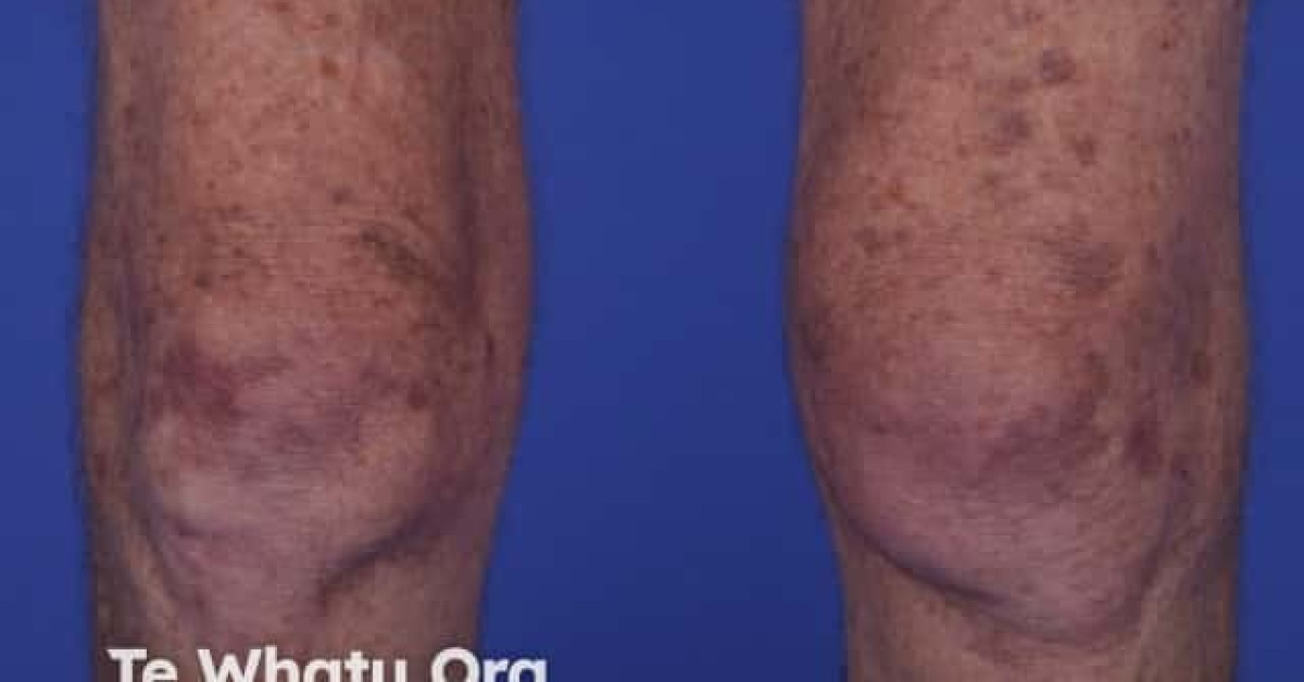 Dermatomyositis Of The Leg Image