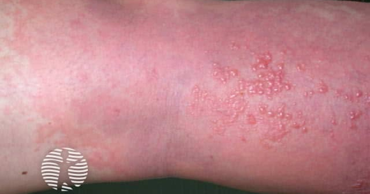 Dermatomyositis of the leg image