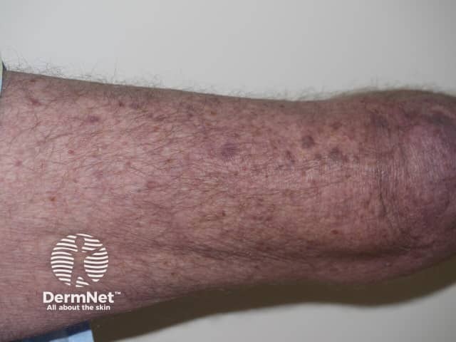 Dermatomyositis of the leg