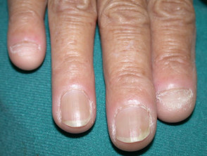 Dermatomyositis of the nail fold