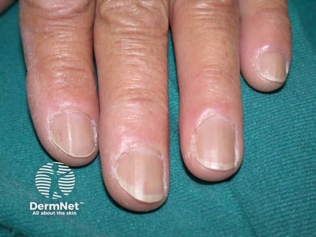 Dermatomyositis of the nailfold
