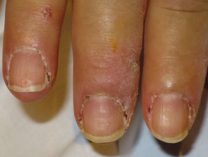 Dermatomyositis of the nailfold