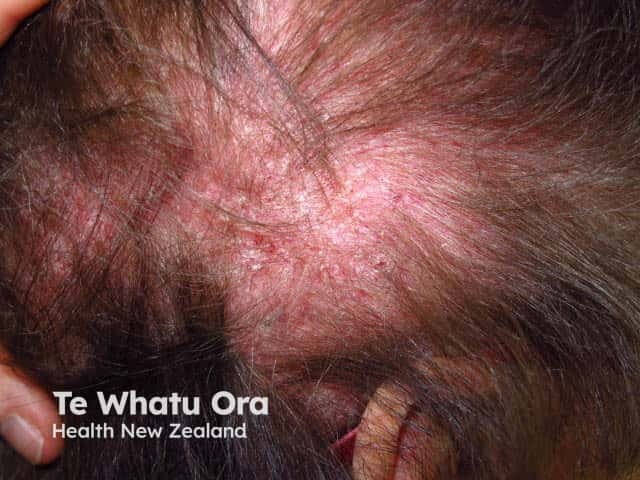 Scaly scalp in dermatomyositis