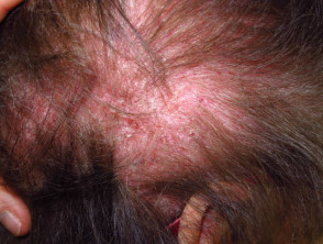 Dermatomyositis of the scalp