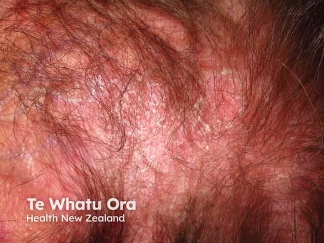 Scaly scalp with hair thinning in dermatomyositis
