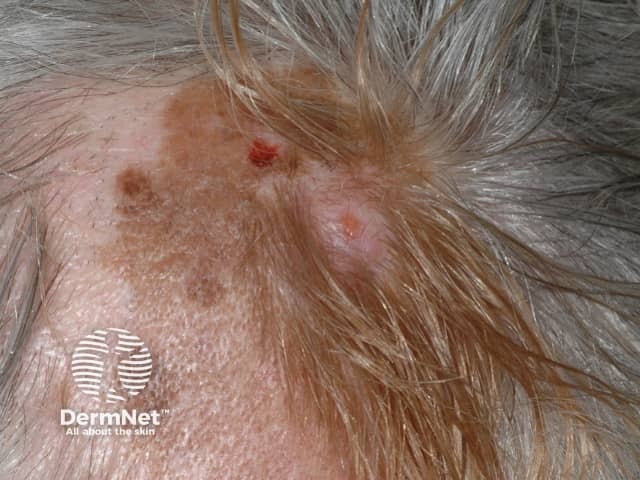 Desmoplastic melanoma, scalp