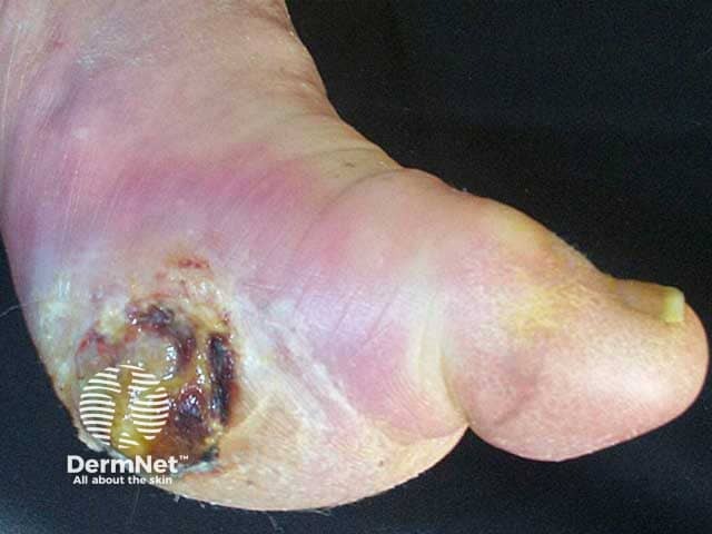 Foot ulcer at a pressure site