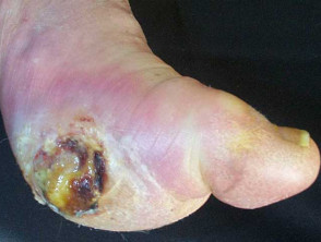 Diabetic foot ulcer