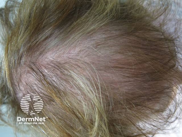Female pattern alopecia