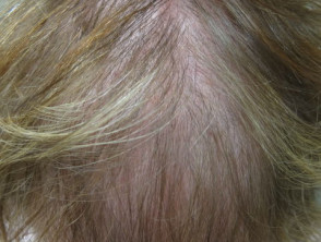 Diffuse alopecia | DermNet