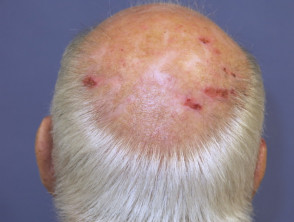 Male pattern alopecia