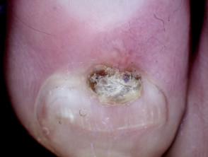 Digital myxoid cyst, toenail