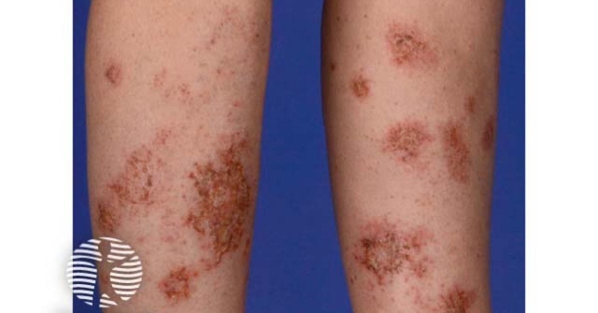 Discoid eczema image