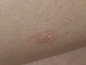 Dry discoid eczema day 0