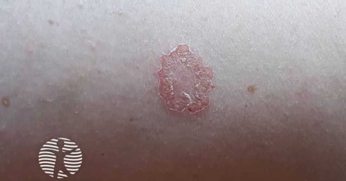 DermNet® - Discoid eczema day 14 image