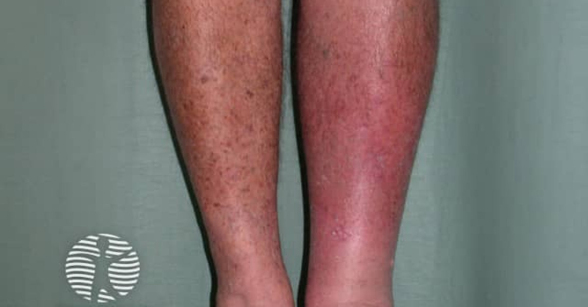 cellulitis image