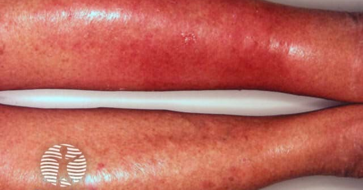 cellulitis image
