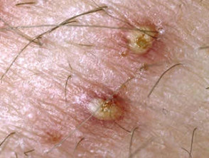 Bacterial skin infections. Folliculitis and furunculosis | DermNet