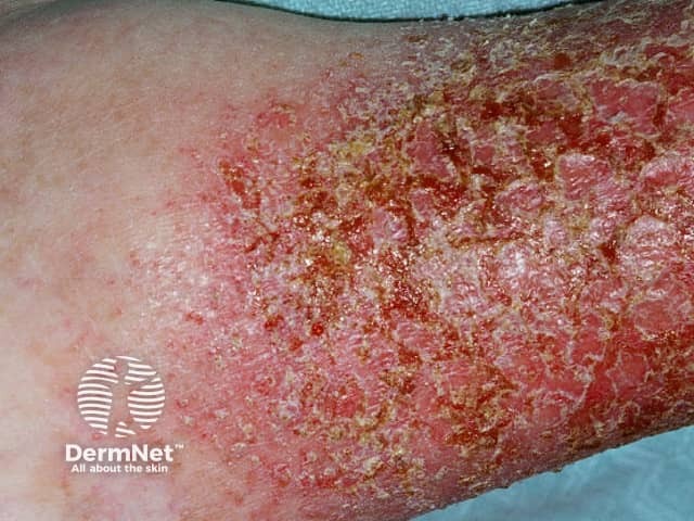 Infection eczema