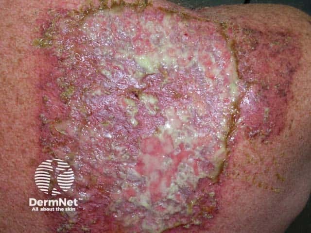 Infection radiation wound