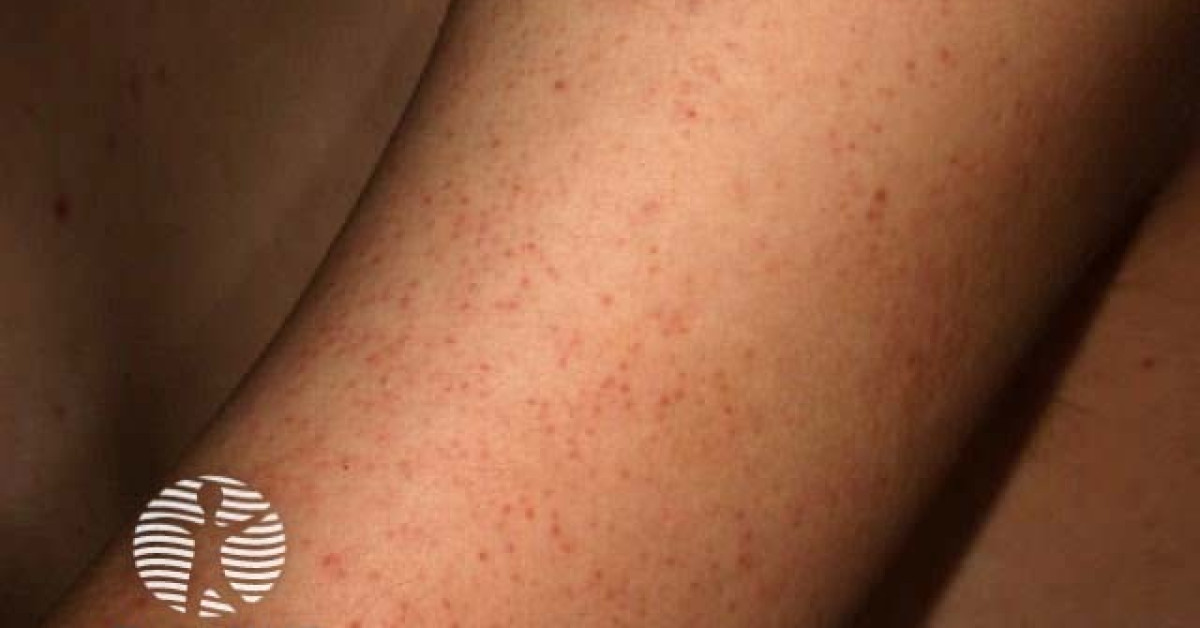 Piliaris Rash Keratosis pilaris image