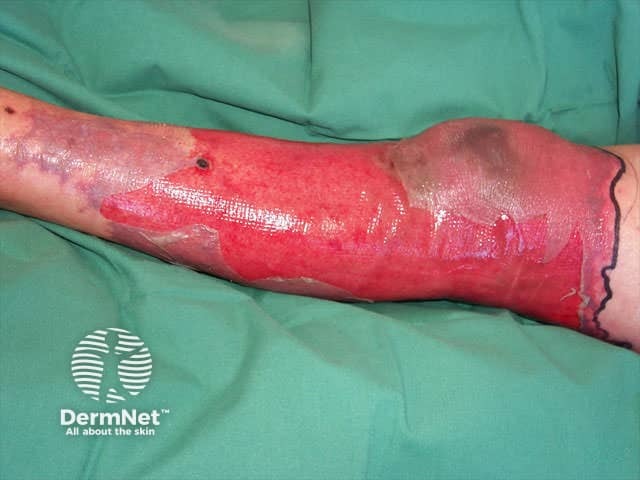 Necrotising fasciitis of the leg after a lower leg infection after injecting heroin