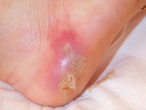 wound infection