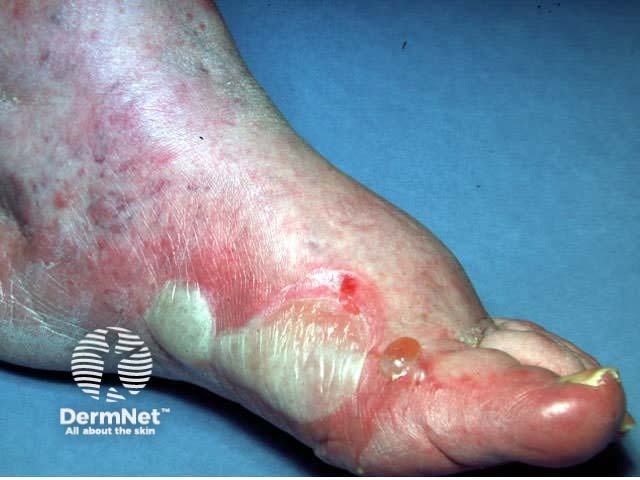 Acute dermatitis