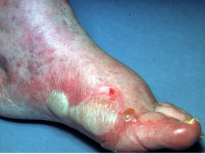 Acute dermatitis