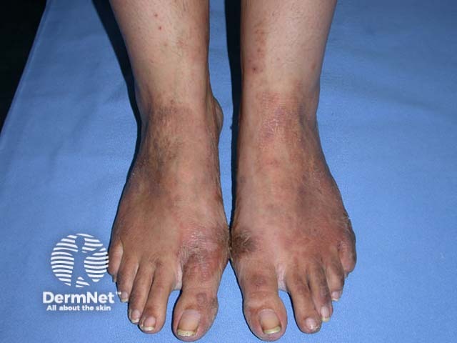 Shoe dermatitis