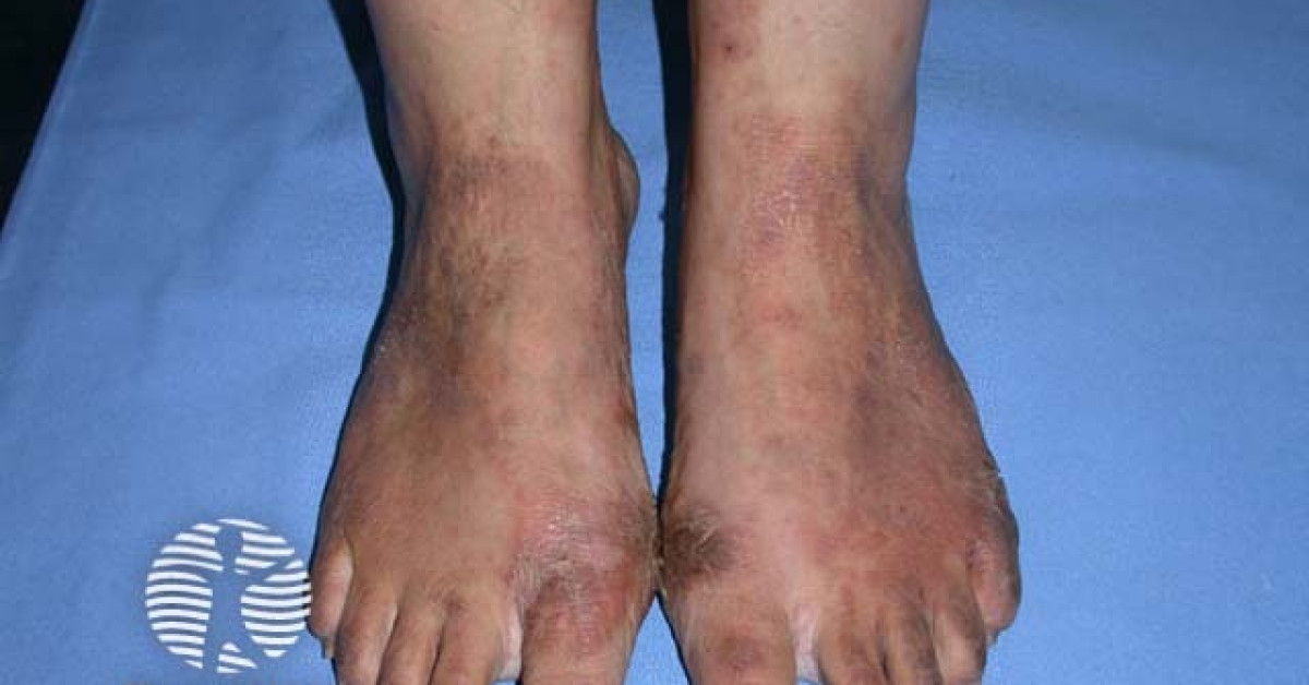 Shoe dermatitis rubber antioxidant allergy image
