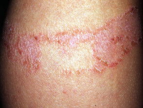 Adhesive plaster dermatitis: rosin (colophony) allergy 