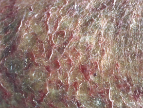 Asteatotic eczema